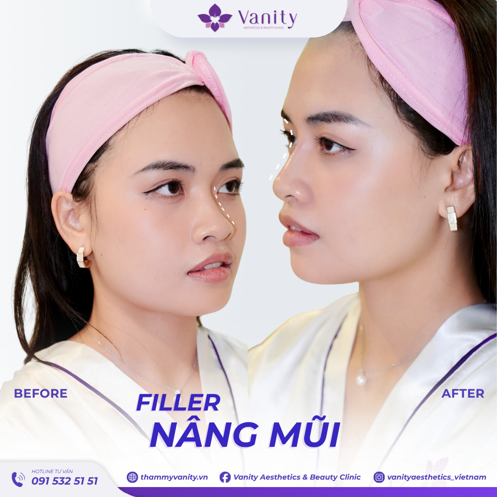 FILLER NÂNG MŨI