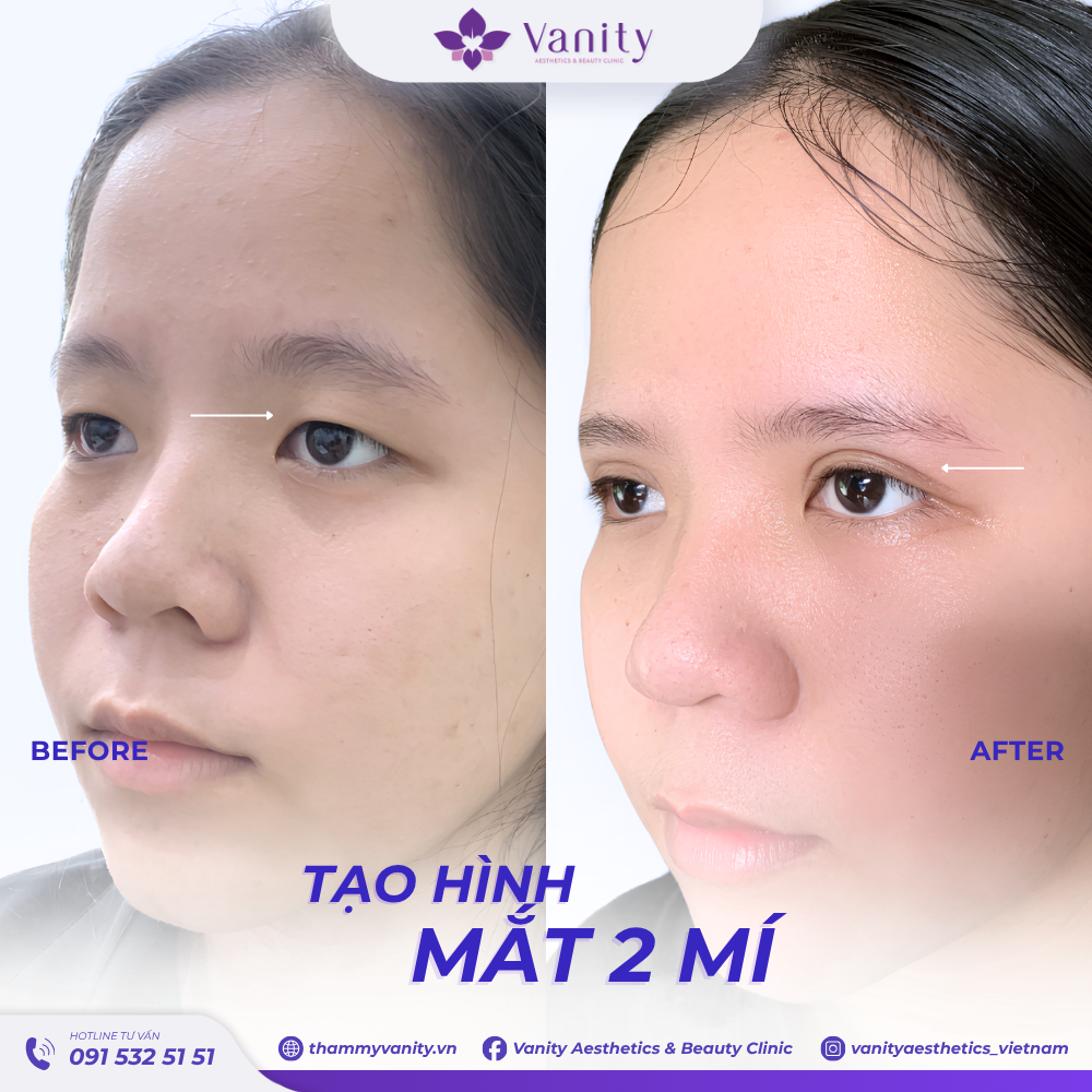 TẠO HÌNH MẮT 2 MÍ