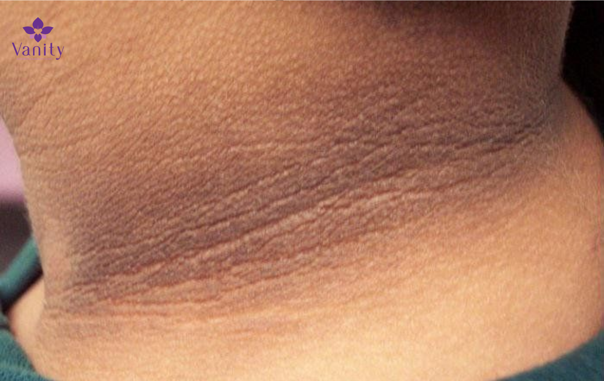 gai-den-la-dau-hieu-nhan-biet-khang-insulin