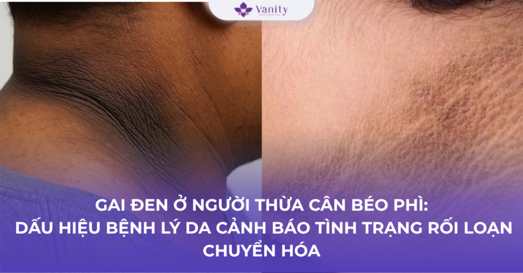 gai-den-o-nguoi-thua-can-beo-phi-dau-hieu-benh-ly-da-canh-bao-tinh-trang-roi-loan-chuyen-hoa